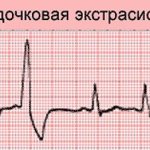 Ventricular extrasystole