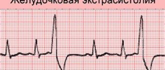 Ventricular extrasystole