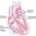 Ventricular tachycardia