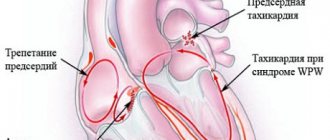 Ventricular tachycardia